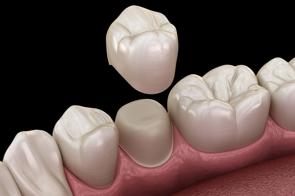Can You Whiten Crowns or Veneers? What You Need to Know
