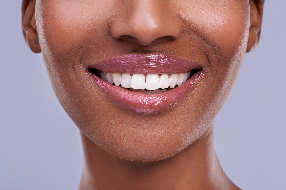 How Long Does Teeth Whitening Last? Tips to Keep Your Smile Bright
